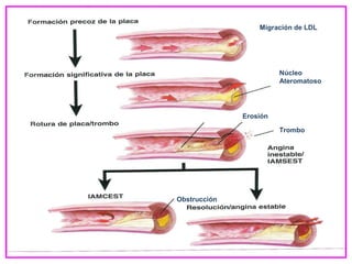 Núcleo
Ateromatoso
Erosión
Migración de LDL
Obstrucción
Trombo
 