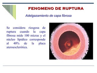 FENOMENO DE RUPTURAFENOMENO DE RUPTURA
Se considera riesgosa de
ruptura cuando la capa
fibrosa mide 100 micras y el
núcleo lipidíco corresponde
al 40% de la placa
ateroesclerótica.
Adelgazamiento de capa fibrosa
 