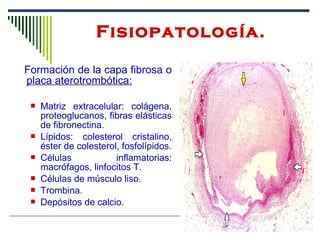 Formación de la capa fibrosa o
placa aterotrombótica:
 Matriz extracelular: colágena,
proteoglucanos, fibras elásticas
de fibronectina.
 Lípidos: colesterol cristalino,
éster de colesterol, fosfolípidos.
 Células inflamatorias:
macrófagos, linfocitos T.
 Células de músculo liso.
 Trombina.
 Depósitos de calcio.
Fisiopatología.
 