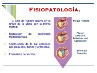 Fisiopatología.
El sitio de ruptura ocurre en la
unión de la placa con la íntima
normal.
1. Exposición de sustancias
trombogénicas
2. Obstrucción de la luz coronaria
por plaquetas, fibrina y eritrocitos.
3. Formación de trombo.
Plaque Rupture
Platelet
Adhesion,
Activation, and
Aggregation
Thrombus
Formation
 