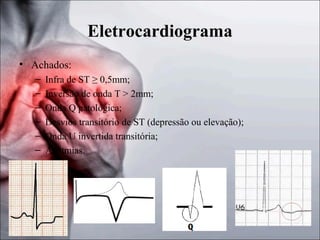 Eletrocardiograma
• Achados:
–
–
–
–
–
–

Infra de ST ≥ 0,5mm;
Inversão de onda T > 2mm;
Onda Q patológica;
Desvios transitório de ST (depressão ou elevação);
Onda U invertida transitória;
Arritmias.

 