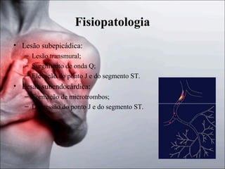 Fisiopatologia
• Lesão subepicádica:
– Lesão transmural;
– Surgimento de onda Q;
– Elevação do ponto J e do segmento ST.

• Lesão subendocárdica:
– Formação de microtrombos;
– Depressão do ponto J e do segmento ST.

 
