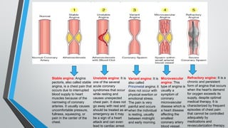 Newer Pharmacological Treatments for Angina Pectoris: Mechanisms and ...