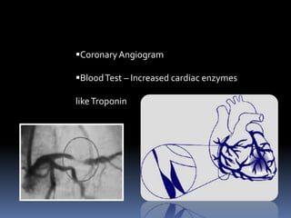 CoronaryAngiogram
BloodTest – Increased cardiac enzymes
likeTroponin
 