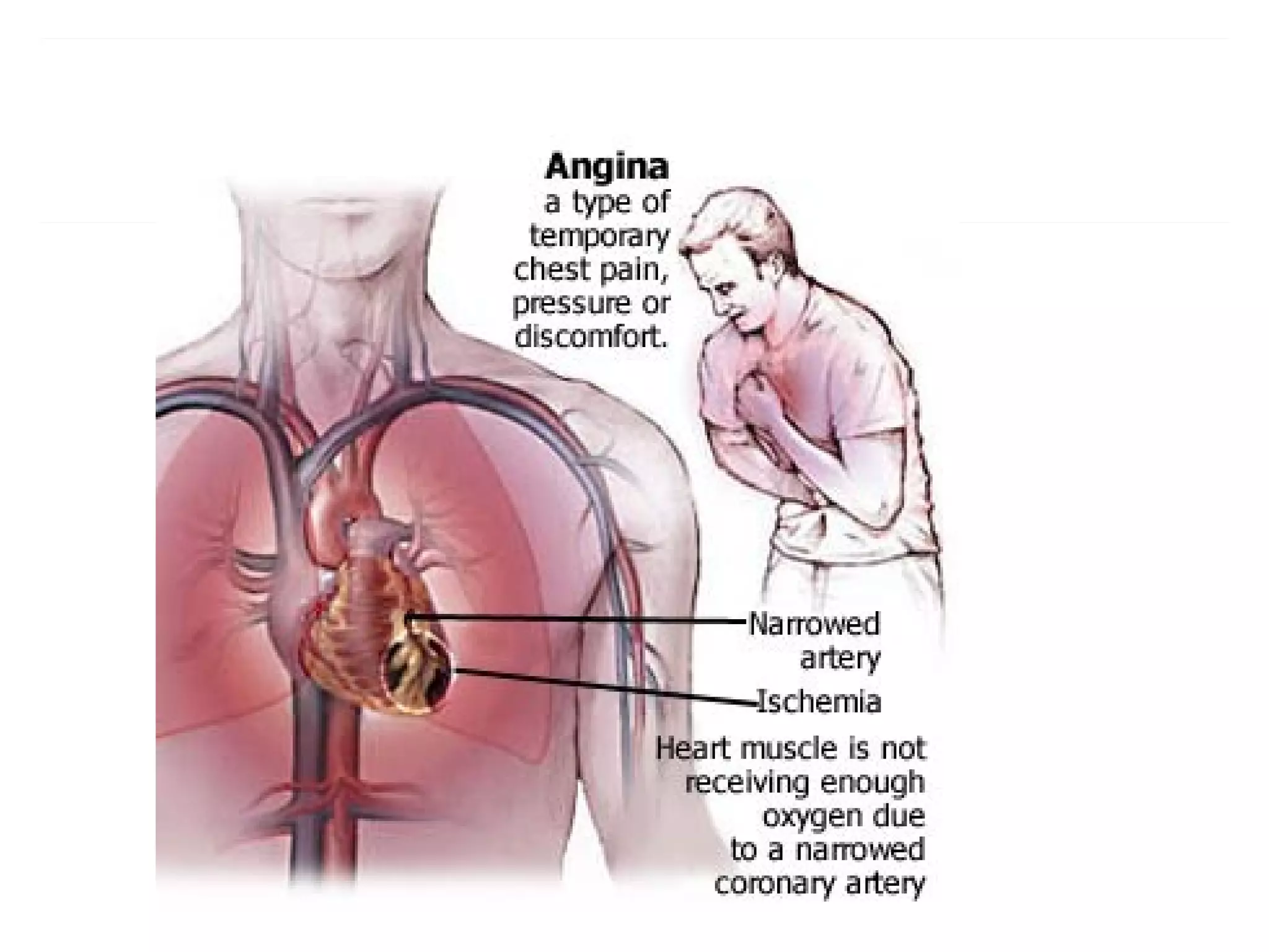 Angina pectoris | PPT