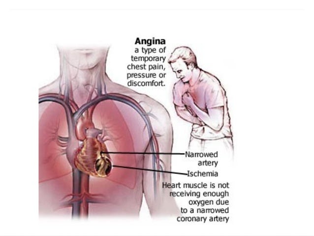 Angina pectoris