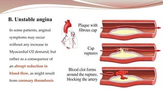 In some patients, anginal
symptoms may occur
without any increase in
Myocardial O2 demand, but
rather as a consequence of
an abrupt reduction in
blood flow, as might result
from coronary thrombosis
B. Unstable angina
 