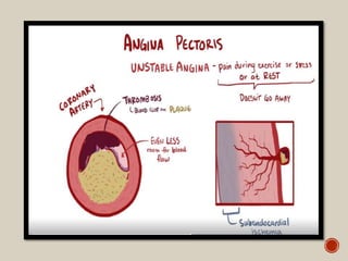 Angina pectoris | PPTX