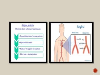 Angina pectoris | PPTX