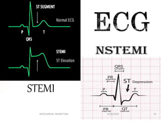 4/20/2020 16MYOCARDIAL INFARCTION
STEMI
 