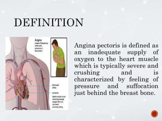 Angina pectoris is defined as
an inadequate supply of
oxygen to the heart muscle
which is typically severe and
crushing and is
characterized by feeling of
pressure and suffocation
just behind the breast bone.
 