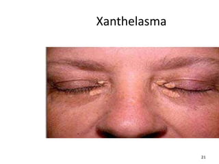 21
Xanthelasma
 