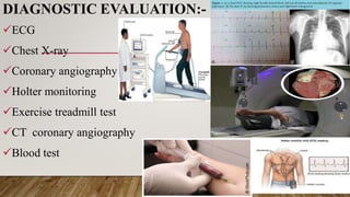 Angina pectoris.pdf