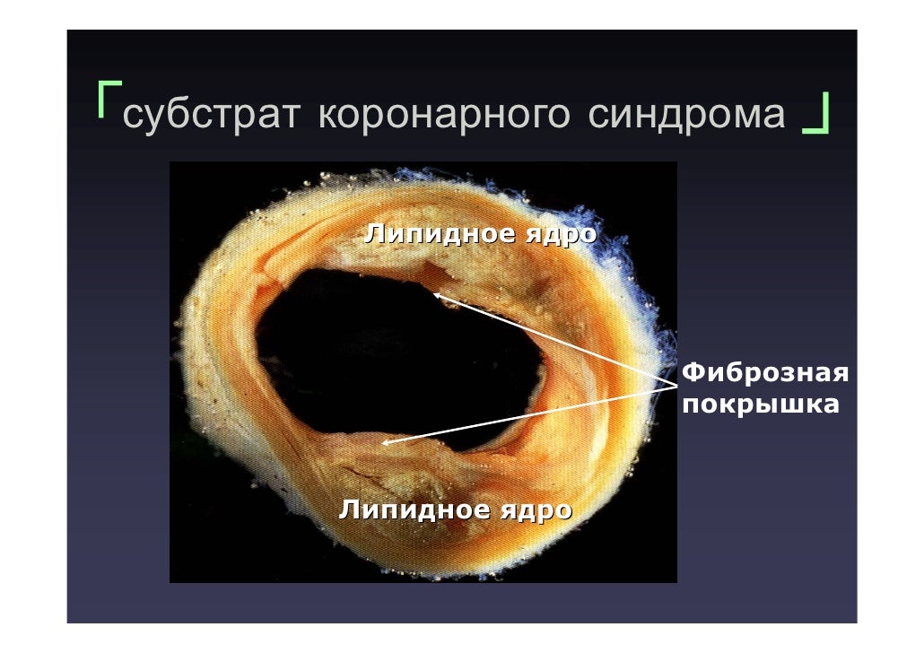Рено кардиальный синдром