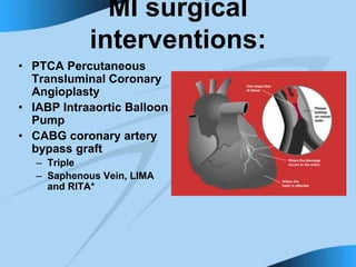 MI surgical
interventions:
• PTCA Percutaneous
Transluminal Coronary
Angioplasty
• IABP Intraaortic Balloon
Pump
• CABG coronary artery
bypass graft
– Triple
– Saphenous Vein, LIMA
and RITA*
 