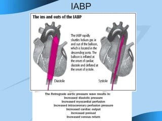 IABP
Intra aortic Balloon Pump
 