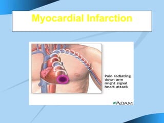 Myocardial Infarction
 