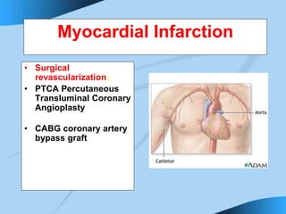 Myocardial Infarction
• Surgical
revascularization:
• PTCA Percutaneous
Transluminal Coronary
Angioplasty
• CABG coronary artery
bypass graft
 