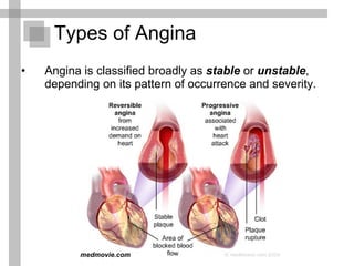Types of Angina Angina is classified broadly as  stable  or  unstable , depending on its pattern of occurrence and severity.  medmovie.com 