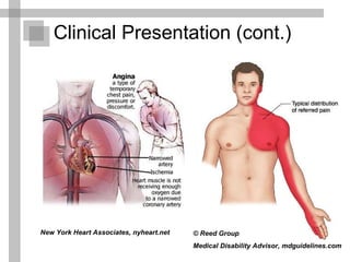 Clinical Presentation (cont.) © Reed Group  Medical Disability Advisor, mdguidelines.com   New York Heart Associates, nyheart.net   