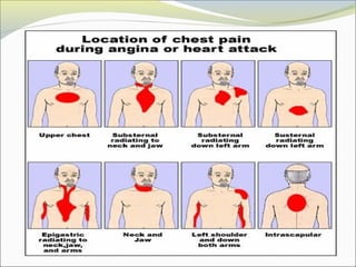 Angina pathophysiology | PPT
