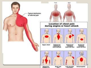 Angina PPT.ppt