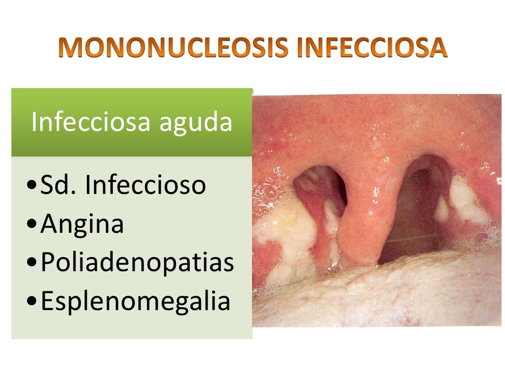 Anginas de las enfermedades infectocontagiosas