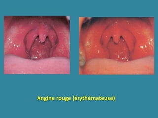 ANGINES.pptx