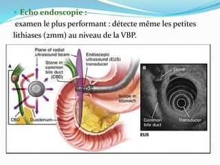 Echo endoscopie :
examen le plus performant : détecte même les petites
lithiases (2mm) au niveau de la VBP.
 