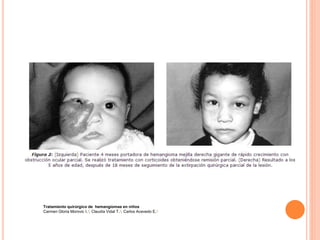 Tratamiento quirúrgico de hemangiomas en niños
Carmen Gloria Morovic I.1; Claudia Vidal T.1; Carlos Acevedo E.1
 