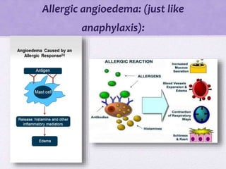 Allergic angioedema: (just like
anaphylaxis):
 
