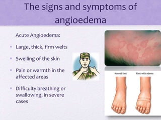 The signs and symptoms of
angioedema
Acute Angioedema:
 Large, thick, firm welts
 Swelling of the skin
 Pain or warmth in the
affected areas
 Difficulty breathing or
swallowing, in severe
cases
 