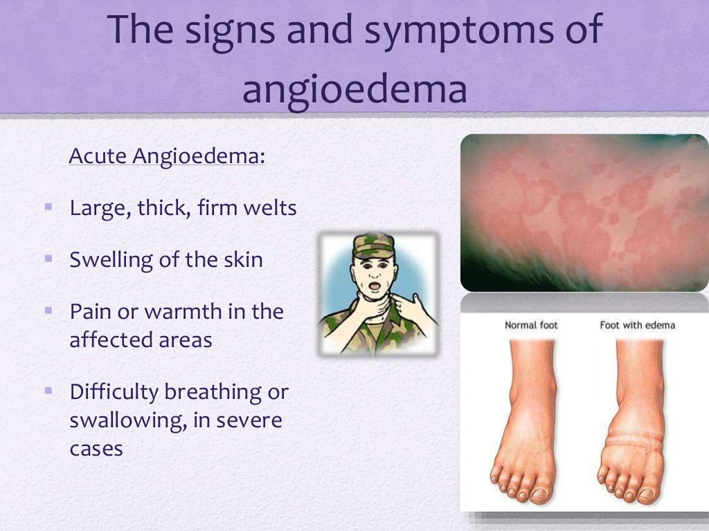 Angioedema angioedema