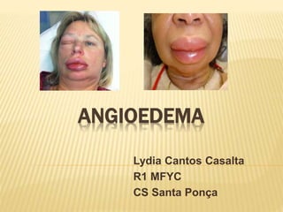 ANGIOEDEMA
Lydia Cantos Casalta
R1 MFYC
CS Santa Ponça
 