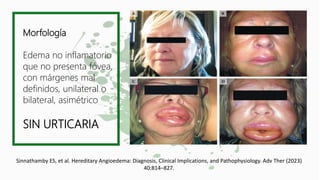 Morfología
Edema no inflamatorio
que no presenta fóvea,
con márgenes mal
definidos, unilateral o
bilateral, asimétrico
SIN URTICARIA
Sinnathamby ES, et al. Hereditary Angioedema: Diagnosis, Clinical Implications, and Pathophysiology. Adv Ther (2023)
40:814–827.
 