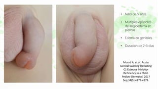 • Niño de 5 años
• Múltiples episodios
de angioedema en
piernas
• Edema en genitales
• Duración de 2-3 días
Murad A, et al. Acute
Genital Swelling Heralding
C1 Esterase Inhibitor
Deficiency in a Child.
Pediatr Dermatol. 2017
Sep;34(5):e277-e278.
 