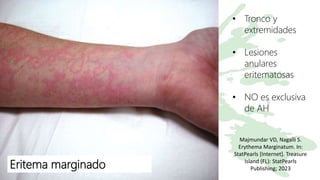 Eritema marginado
• Tronco y
extremidades
• Lesiones
anulares
eritematosas
• NO es exclusiva
de AH
Majmundar VD, Nagalli S.
Erythema Marginatum. In:
StatPearls [Internet]. Treasure
Island (FL): StatPearls
Publishing; 2023
 