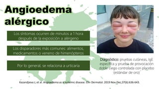 Los síntomas ocurren de minutos a 1 hora
después de la exposición a alérgeno
Los disparadores más comunes: alimentos,
medicamentos o veneno de himenópteros
Por lo general, se relaciona a urticaria
Diagnóstico: pruebas cutáneas, IgE
específica y prueba de provocación
doble ciego controlada con placebo
(estándar de oro)
Angioedema
alérgico
Kazandjieva J, et al. Angioedema as a systemic disease. Clin Dermatol. 2019 Nov-Dec;37(6):636-643.
 