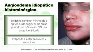 Se define como un mínimo de 3
episodios de angioedema en un
periodo de 6-12 meses SIN una
causa identificada
Responde a antihistamínicos y
esteroides
Angioedema idiopático
histaminérgico
Holguín-Gómez y Cols. Angioedema. Rev Alerg Mex. 2016;63(4):373-384.
 