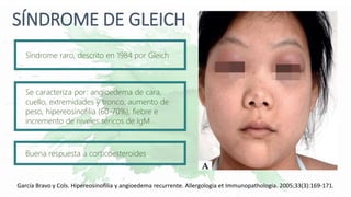 SÍNDROME DE GLEICH
Síndrome raro, descrito en 1984 por Gleich
Se caracteriza por: angioedema de cara,
cuello, extremidades y tronco, aumento de
peso, hipereosinofilia (60-70%), fiebre e
incremento de niveles séricos de IgM
Buena respuesta a corticoesteroides
García Bravo y Cols. Hipereosinofilia y angioedema recurrente. Allergologia et Immunopathologia. 2005;33(3):169-171.
 