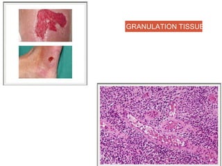 GRANULATION TISSUE
 