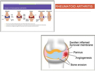 RHEUMATOID ARTHRITIS
 