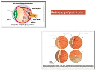 Retinopathy of prematurity
 