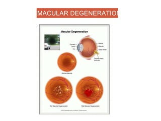 MACULAR DEGENERATION
 