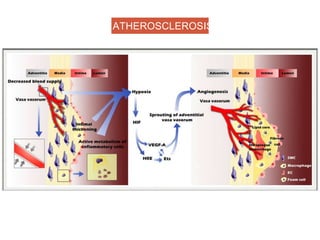ATHEROSCLEROSIS
 
