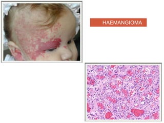 HAEMANGIOMA
 