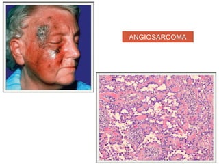 ANGIOSARCOMA
 