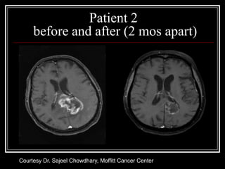 Patient 2
     before and after (2 mos apart)




Courtesy Dr. Sajeel Chowdhary, Moffitt Cancer Center
 