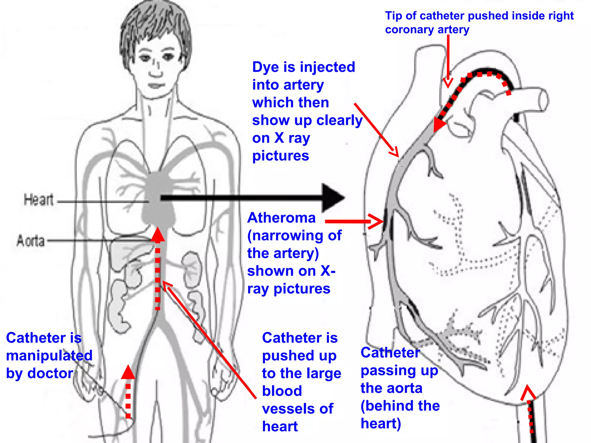Angiogram | PPT