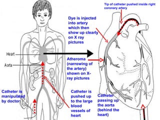 Catheter is manipulated by doctor Catheter is  pushed up to the large blood vessels of heart  Catheter passing up the aorta (behind the heart) Tip of catheter pushed inside right coronary artery Dye is injected into artery which then show up clearly on X ray pictures  Atheroma (narrowing of the artery) shown on X-ray pictures 